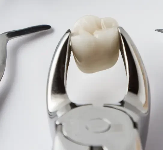 Simple Tooth Extractions