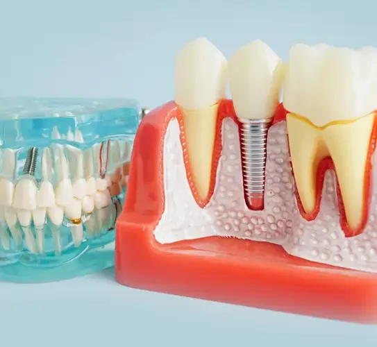 Tooth Implants
