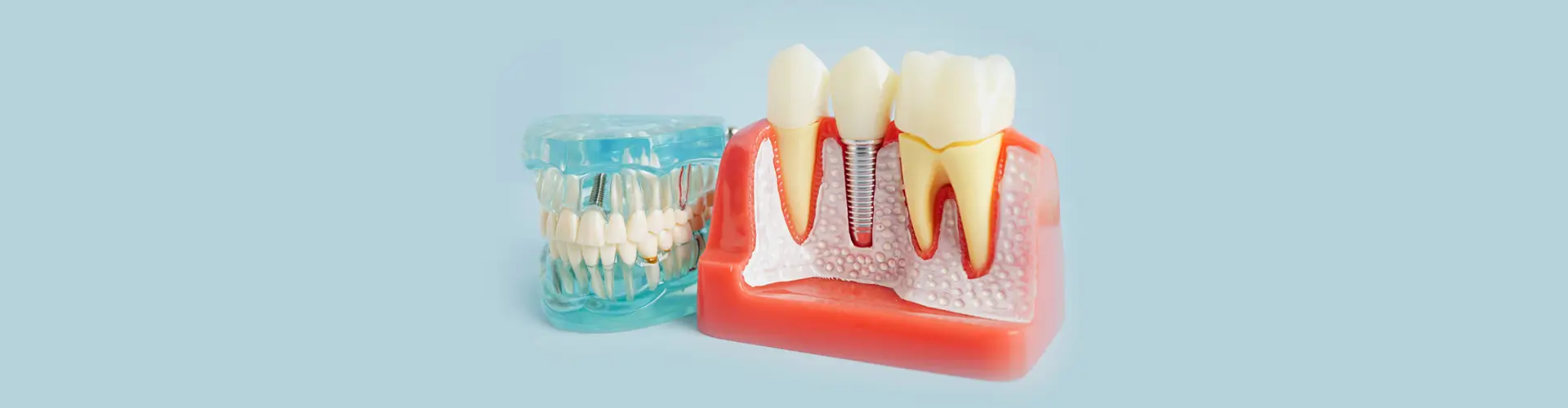 Tooth Implants