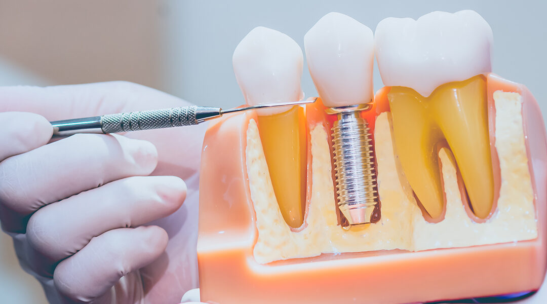 What to Expect When Getting Dental Implants at Dentistry of Norcross?