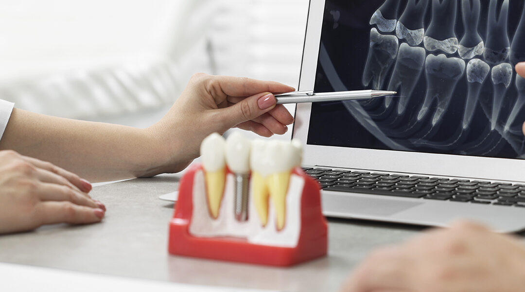 Your Guide to Dental Implants with Dentistry of Norcross