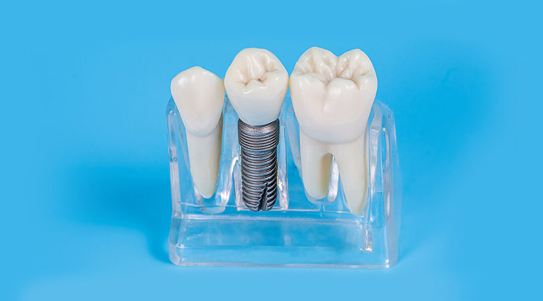 Transform Your Oral Health Getting Dental Implants from Dentistry of Norcross