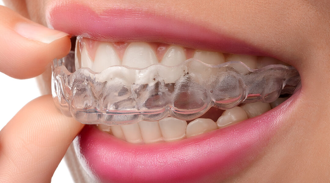 Why Choose Nighttime Aligners? The Advantages of Dental Aligners for Busy Lifestyles