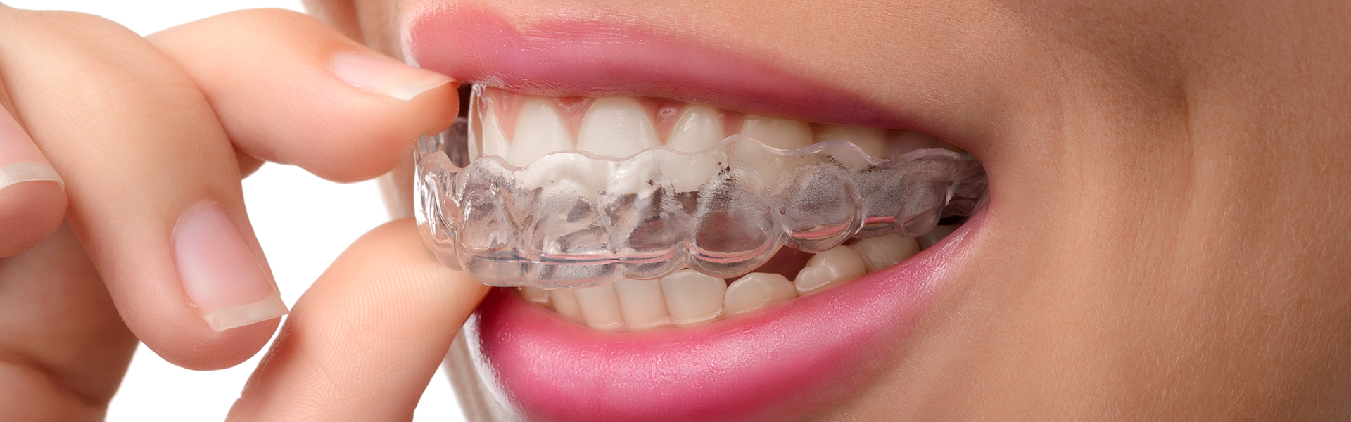 teeth alligners in norcross, dentist in norcross, invisalign near you