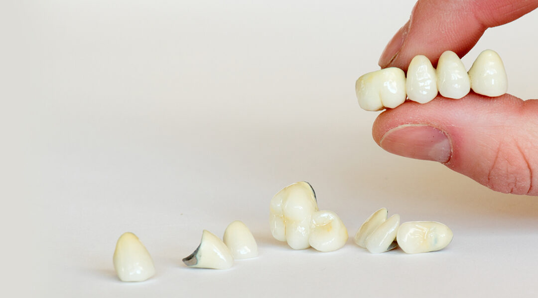 Signs You Might Need a Dental Crown and Where to Go in Norcross