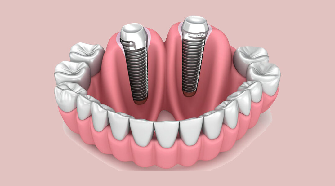 Unlock Your Best Smile: Top Benefits of Dental Implants in Norcross