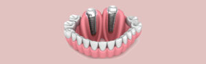 dental implants in Norcross, dental implants near you, dentist in Norcross
