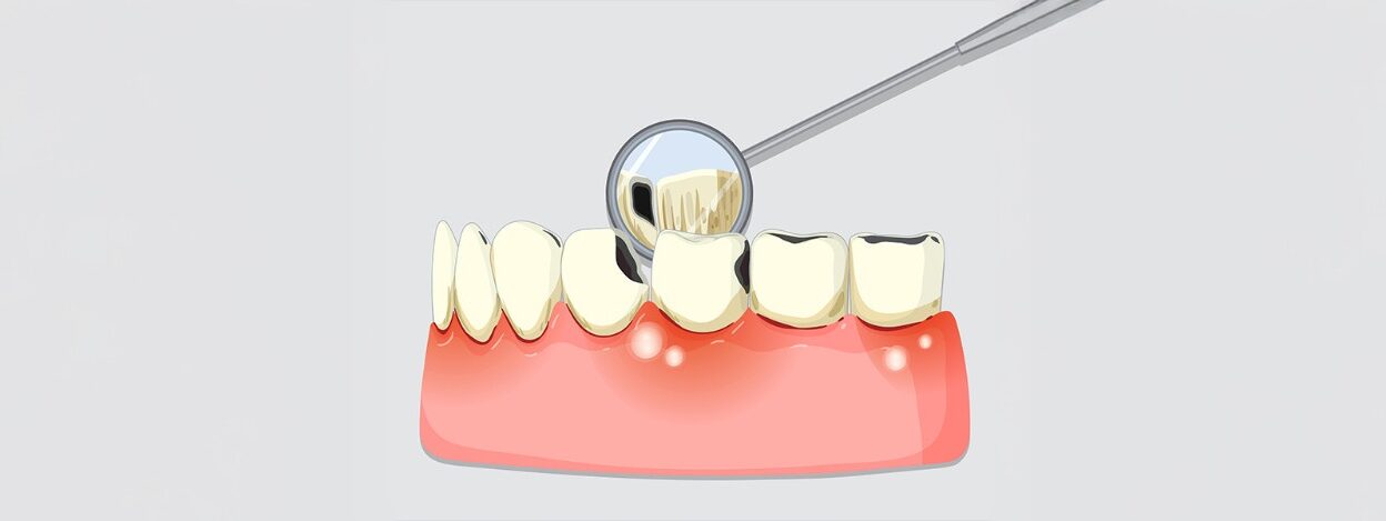Dental Fillings: Understanding the Options Available