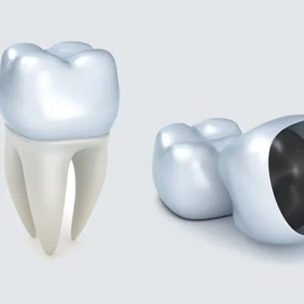 Dental Crowns