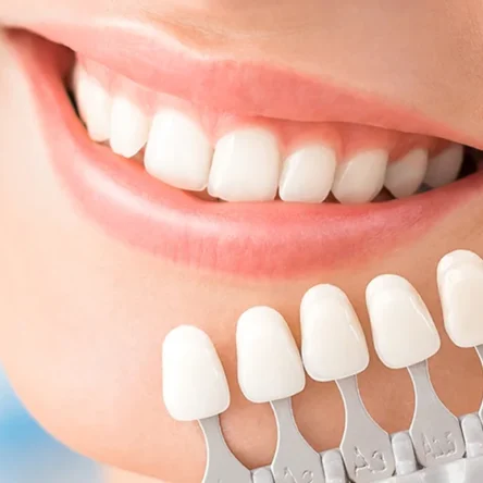 Dental Veneers
