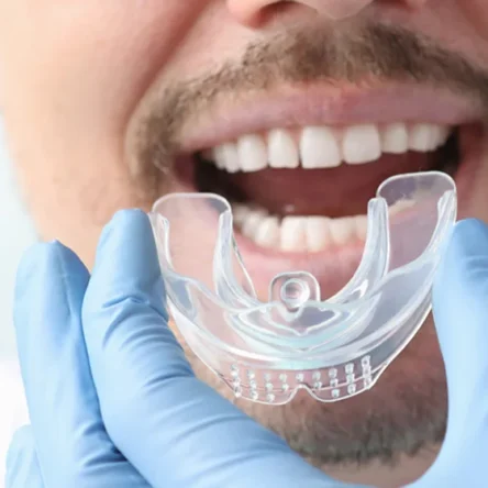 Mouth Guards