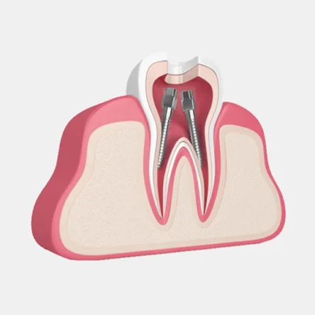 Root Canal Therapy