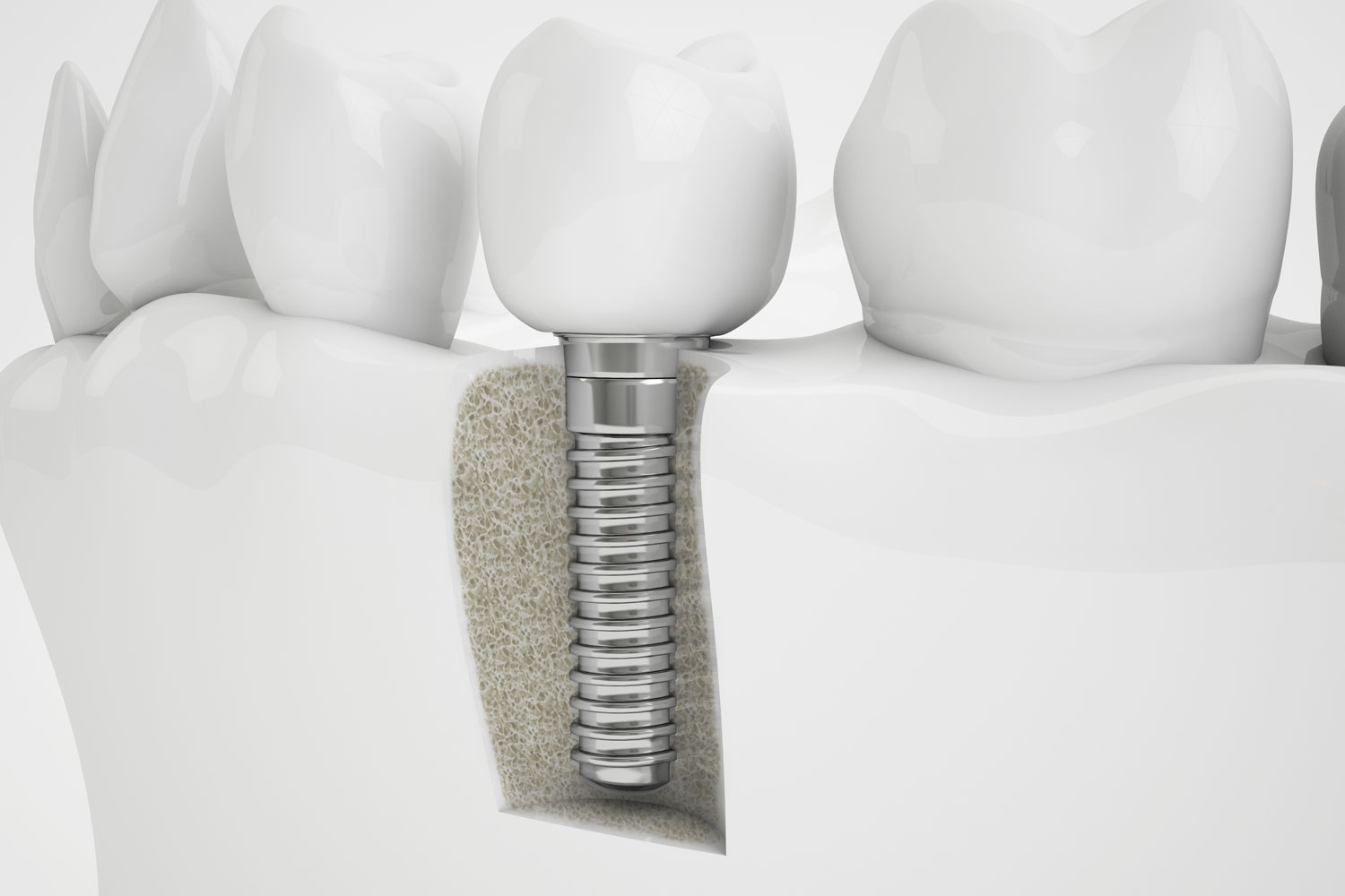bone grafting model Tavares, FL