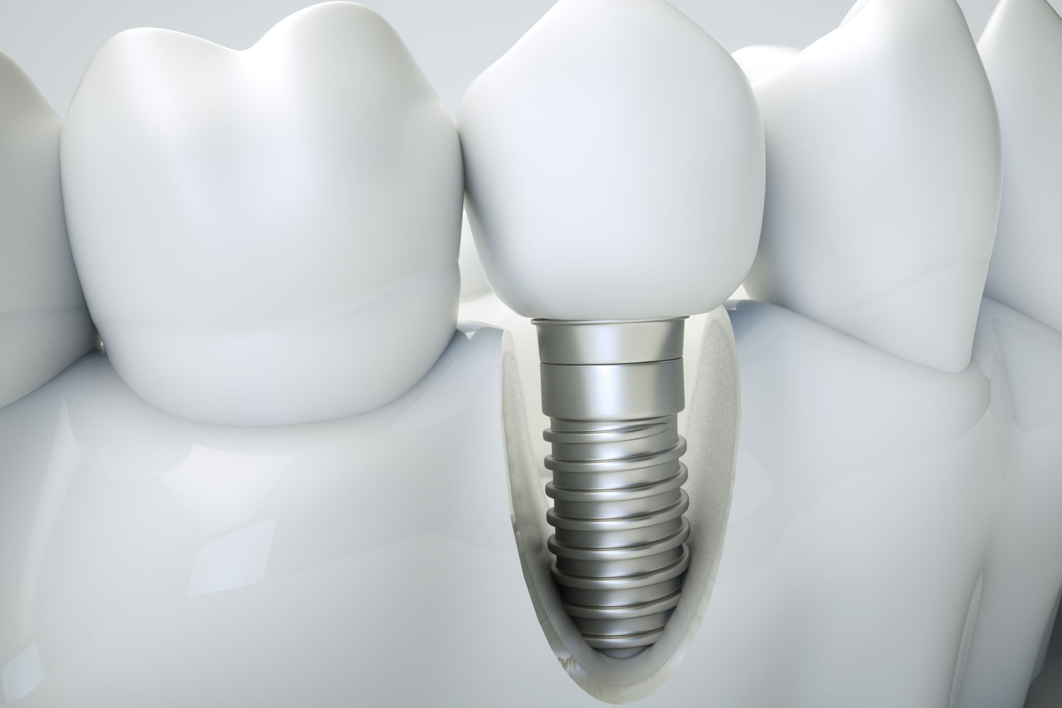 bone grafting model Tavares, FL