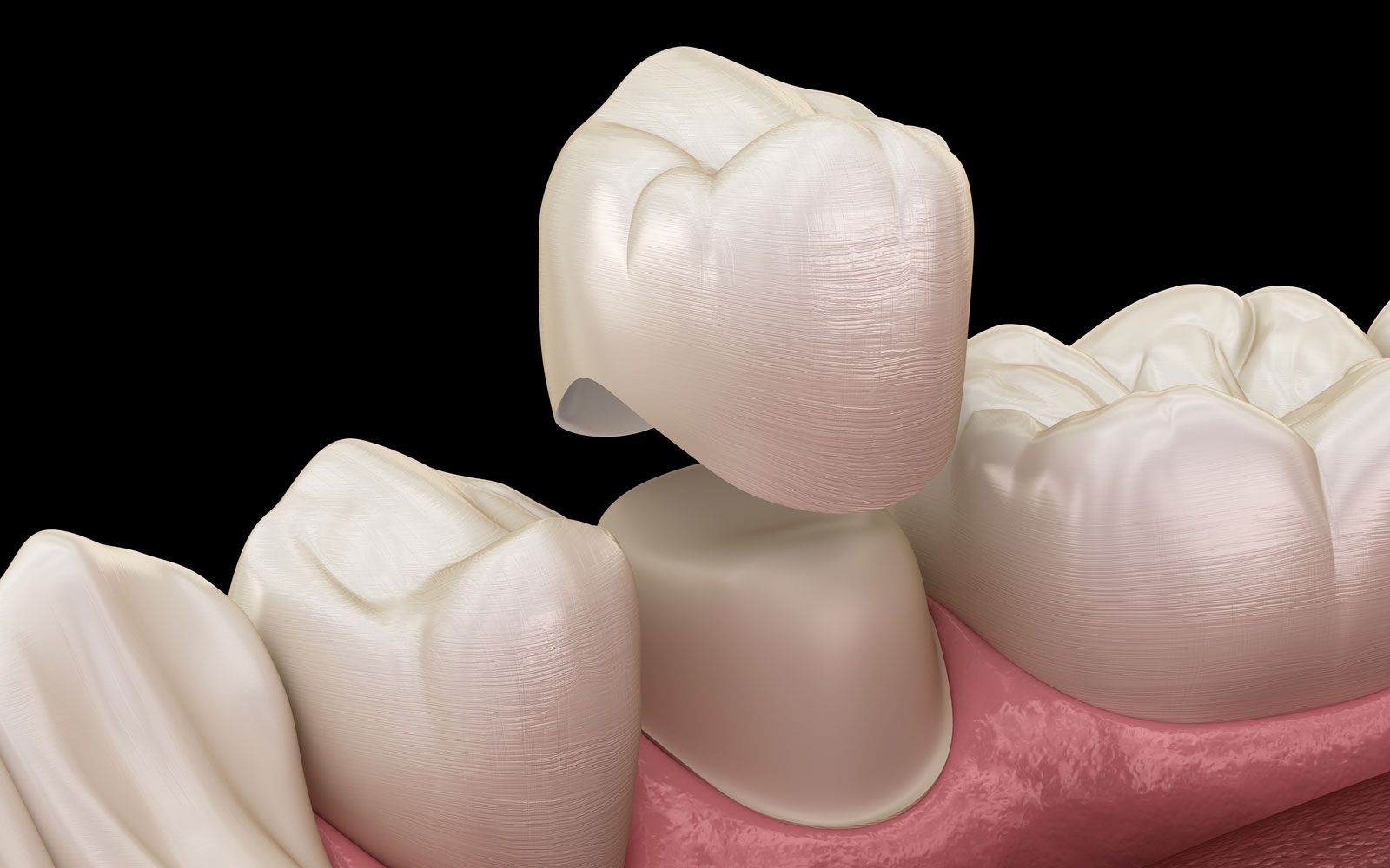 dental crown