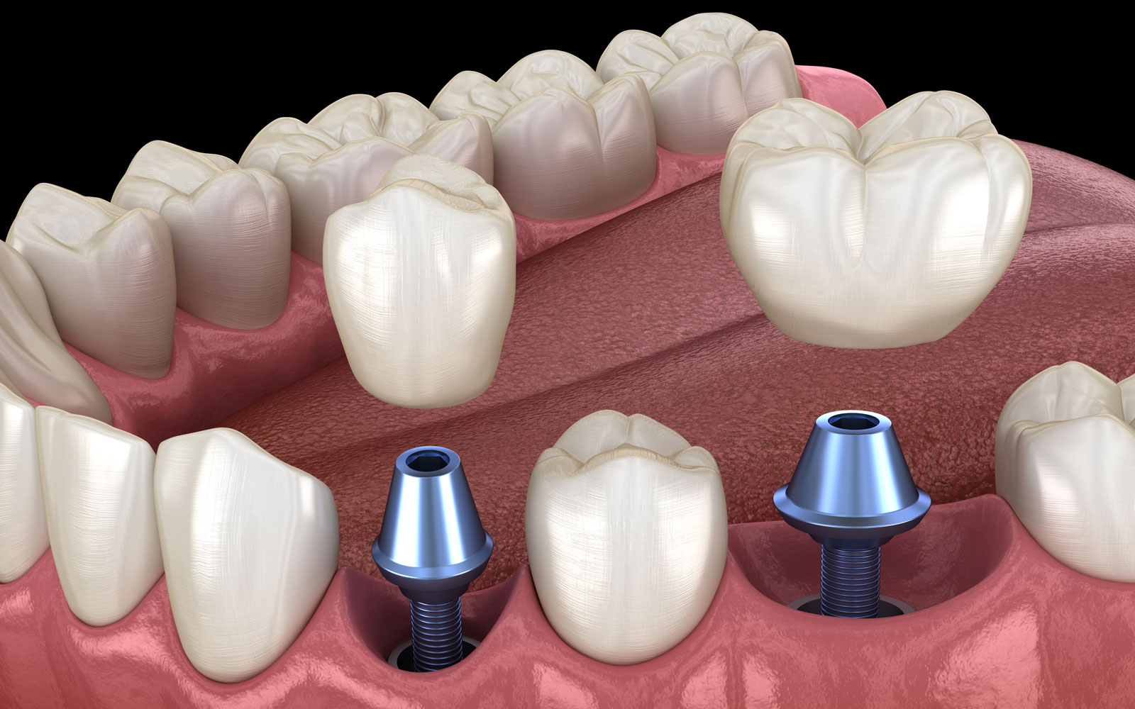 dental implants model