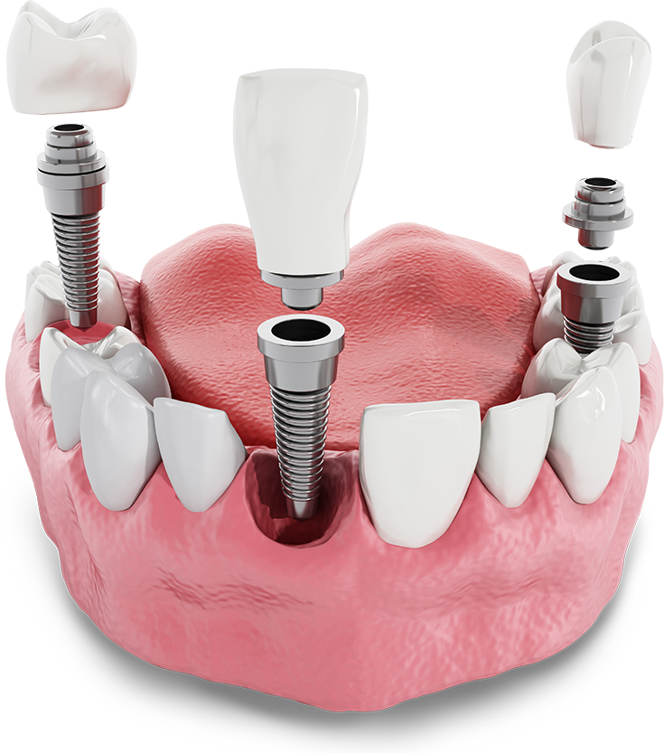 dental implants model Tavares, FL