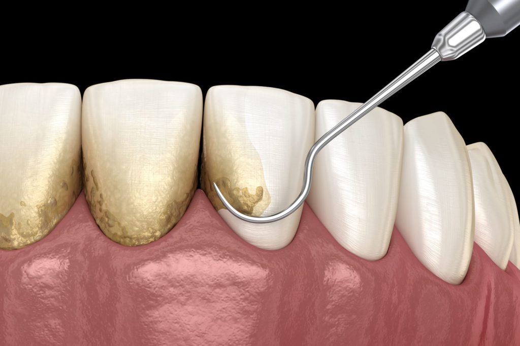 dental scaling procedure graphic Tavares, FL