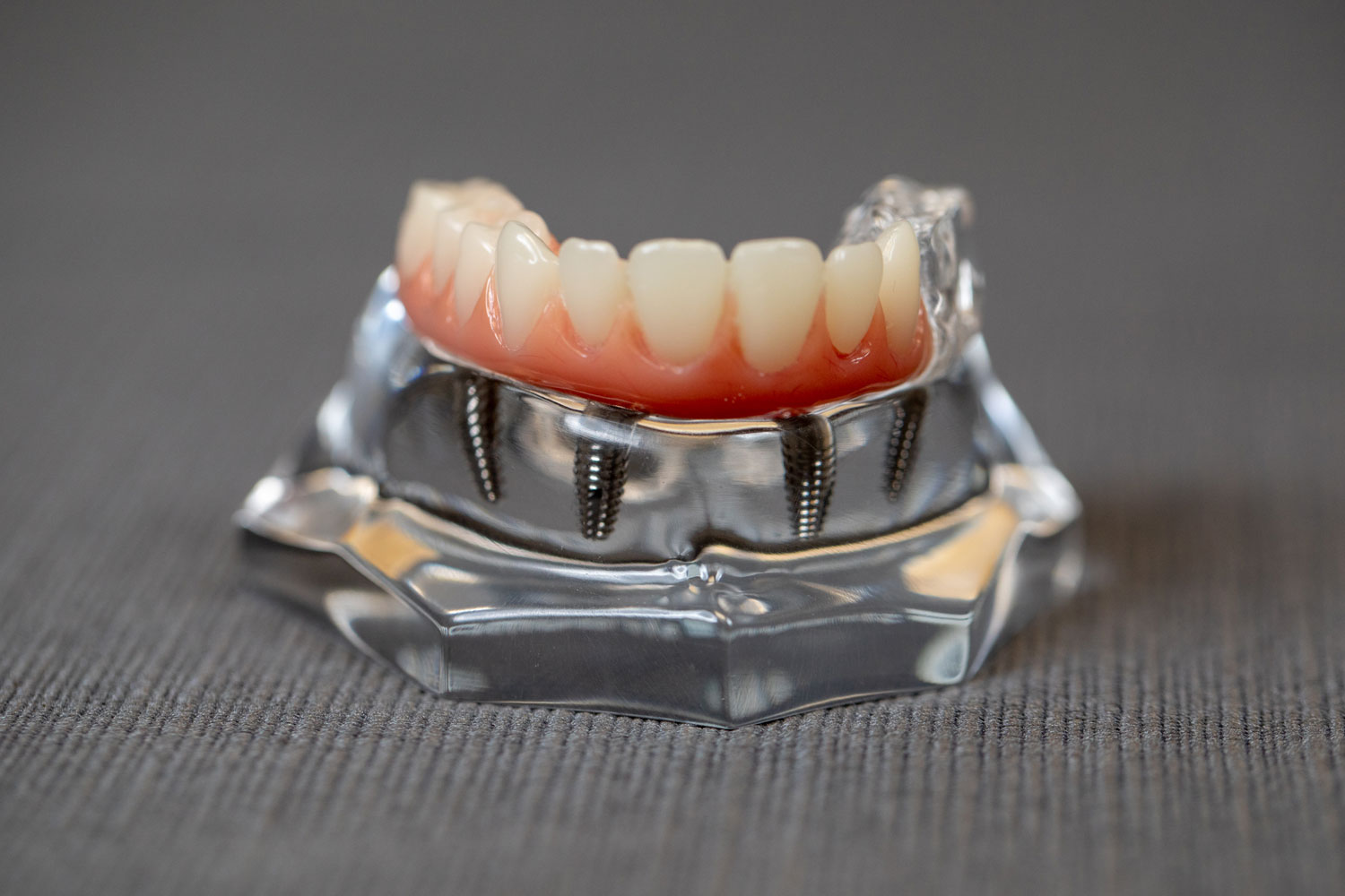 full arch dental implants model Tavares, FL