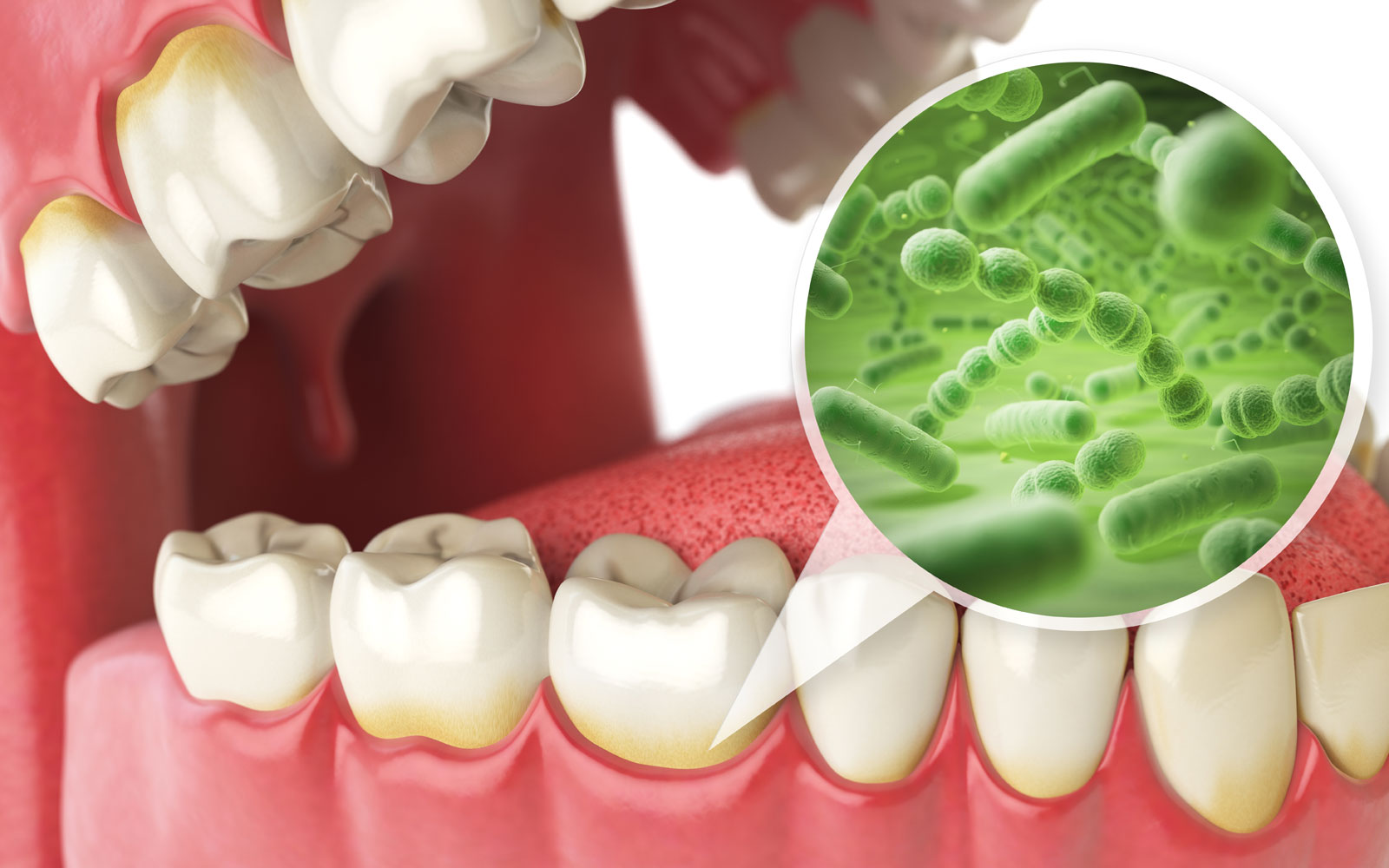 gum disease graphic