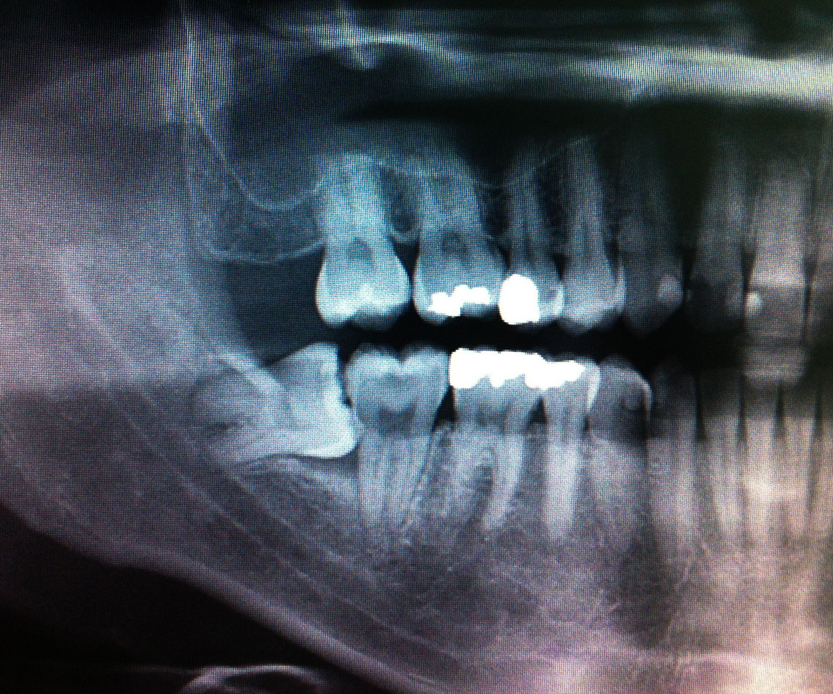 impacted tooth xray Tavares, FL
