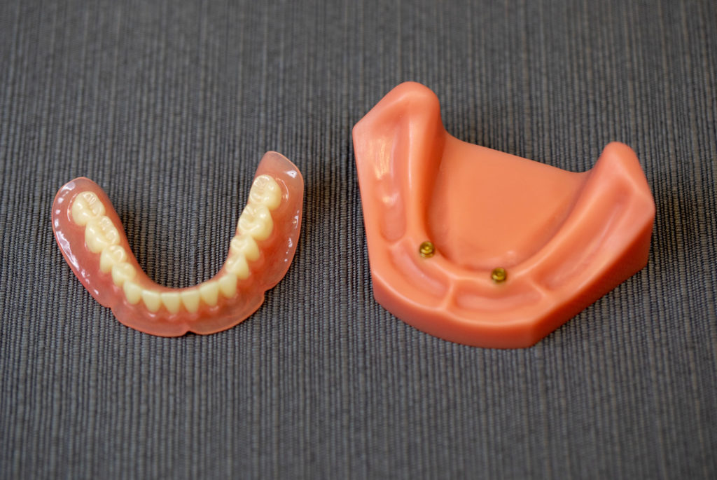 implant supported dentures model Tavares, FL