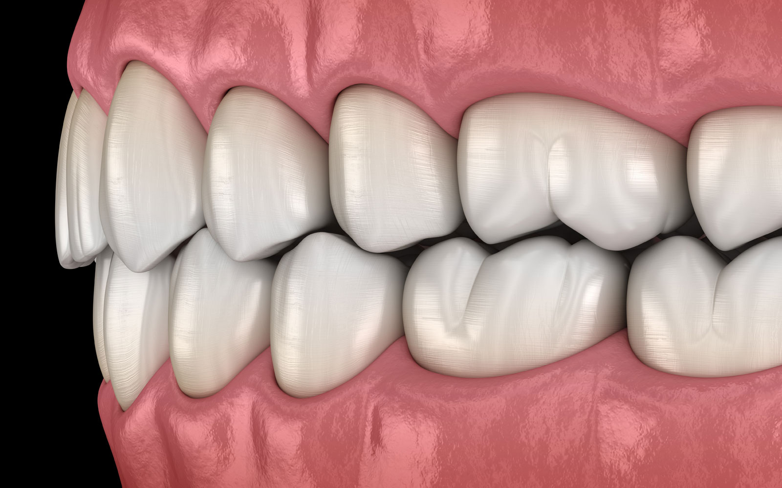 malocclusion model