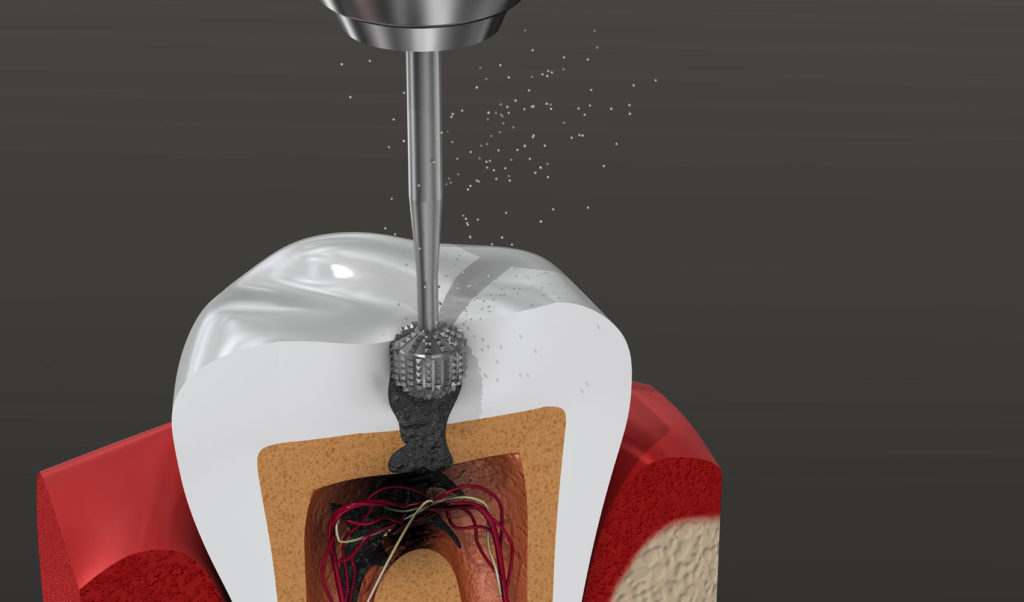 root canal model Tavares, FL
