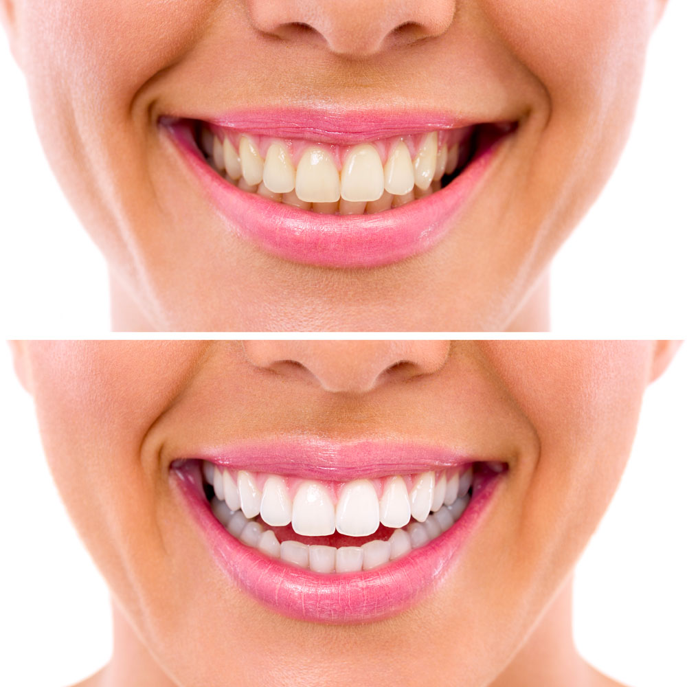 teeth whitening before and after Tavares, FL