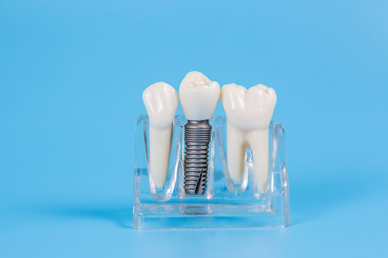 a model of a single dental implant and post.