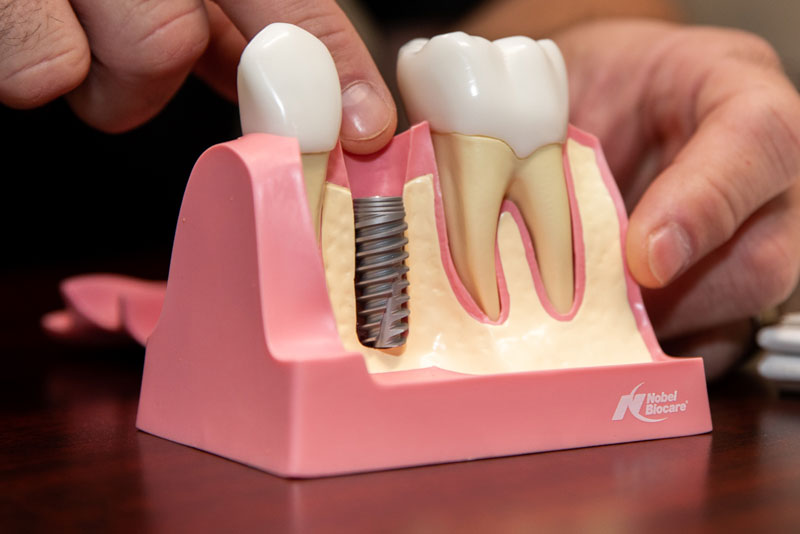 a dental implant post in jaw model.