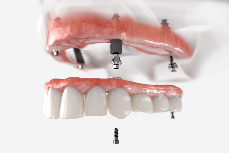 a full mouth dental implant model that shows how they can functionally benefit patients with their strategically placed dental implant posts and custom made prosthesis. The abutment and screws shown in the image help keep the prosthesis in place.