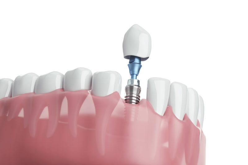 a digital model of a lower arch with a dental implant being placed after a tooth extraction.