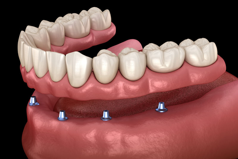 a digital model of a bottom arch showing implant supported dentures.