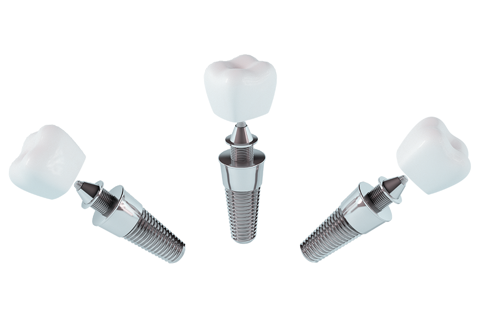 Three Dental Implant Posts Arranged In An Arch