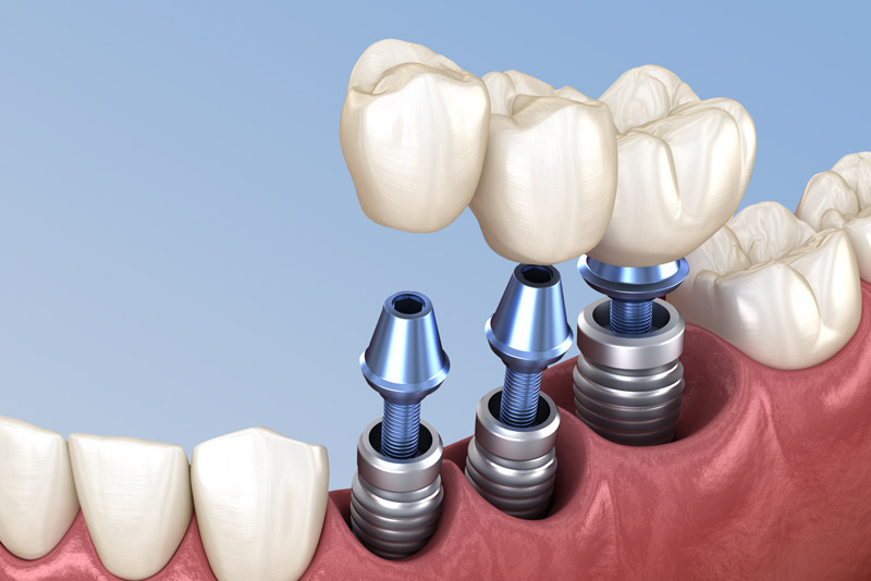An infographic showcasing the dental implants step by step procedure. Include the steps: (1) consultation, (2) implant placement, (3) healing, (4) abutment placement, and (5) crown attachment. No text.