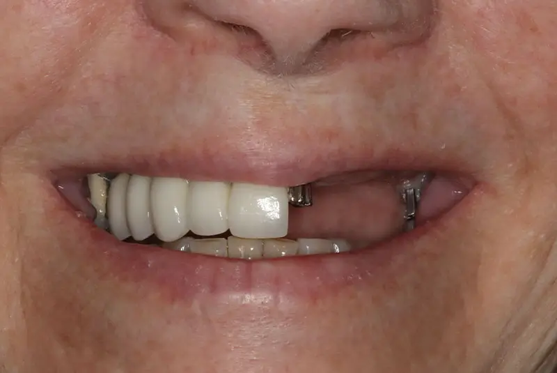 Before