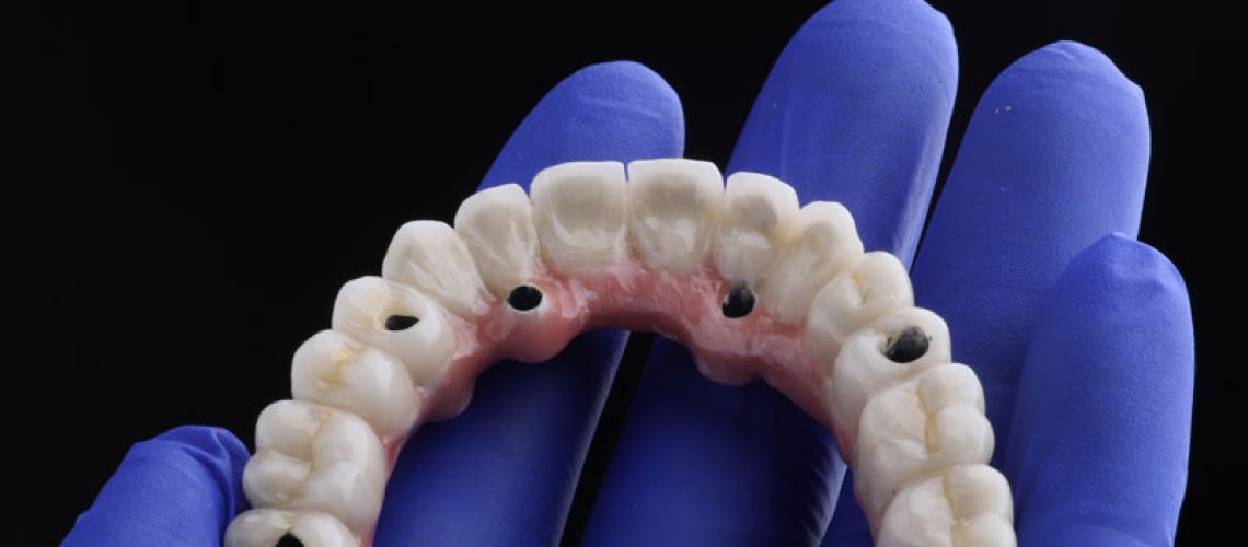 Photo dental implant work is completed and ready to use dental implant temporary abutment, doctor with blue gloves on holding hand flat