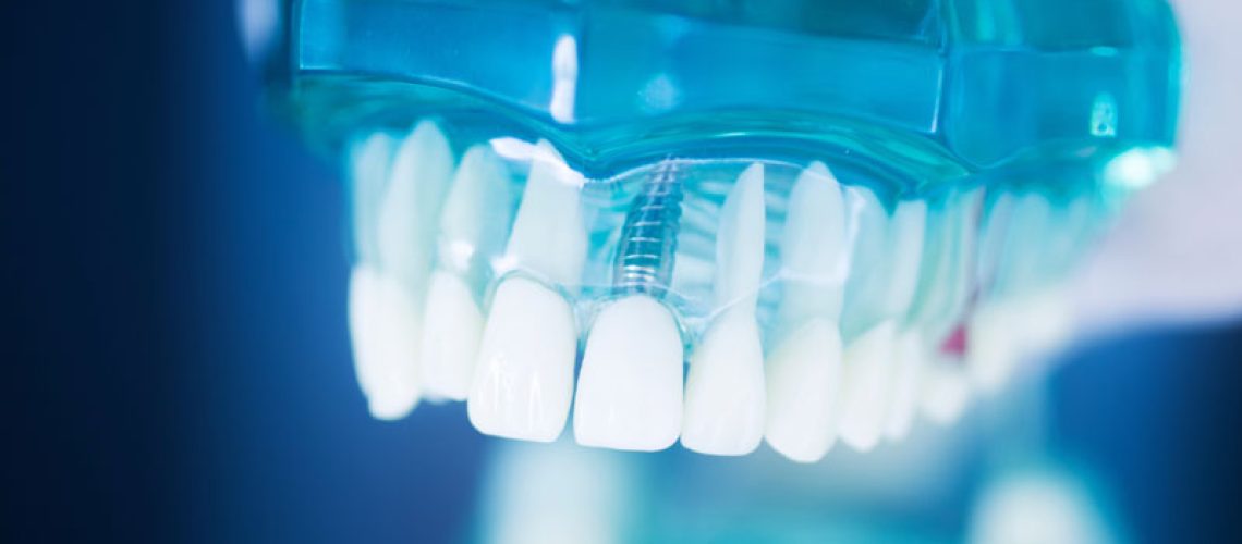 Dental tooth implant titanium prosthetic dentists’ model, image is blurry from being taken up-close. Dental mouth and jaw model with dental implants