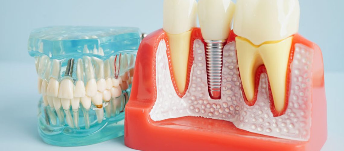 Dental implant, artificial tooth roots into jaw, root canal of dental treatment, gum disease, teeth model for dentist studying about dentistry.