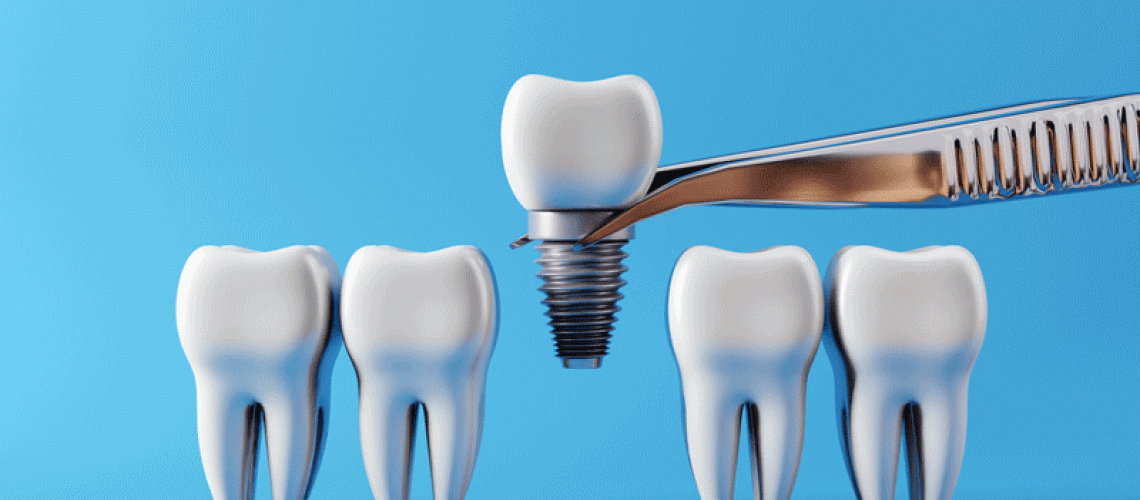 Dental teeth implants and Healthy white teeths. Oral health and dental inspection teeth.