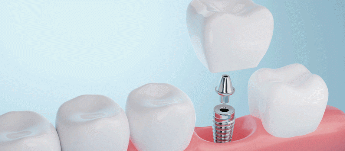 Healthy gums and Dental implant on blue background. 3D rendering