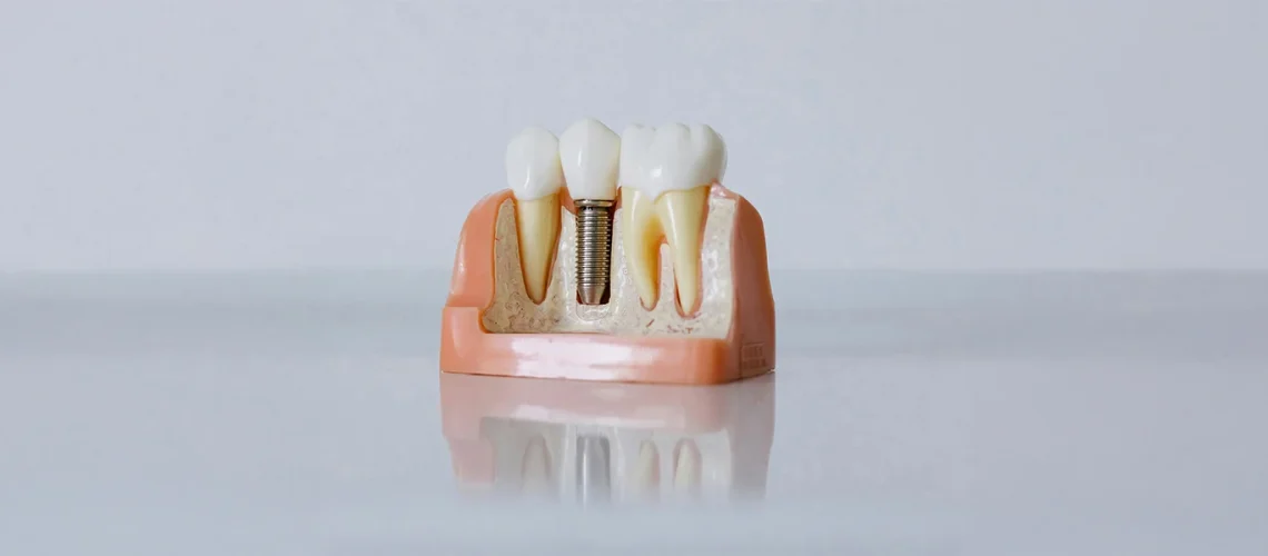 Missing-Teeth-Discover-the-Benefits-of-Dental-Implants