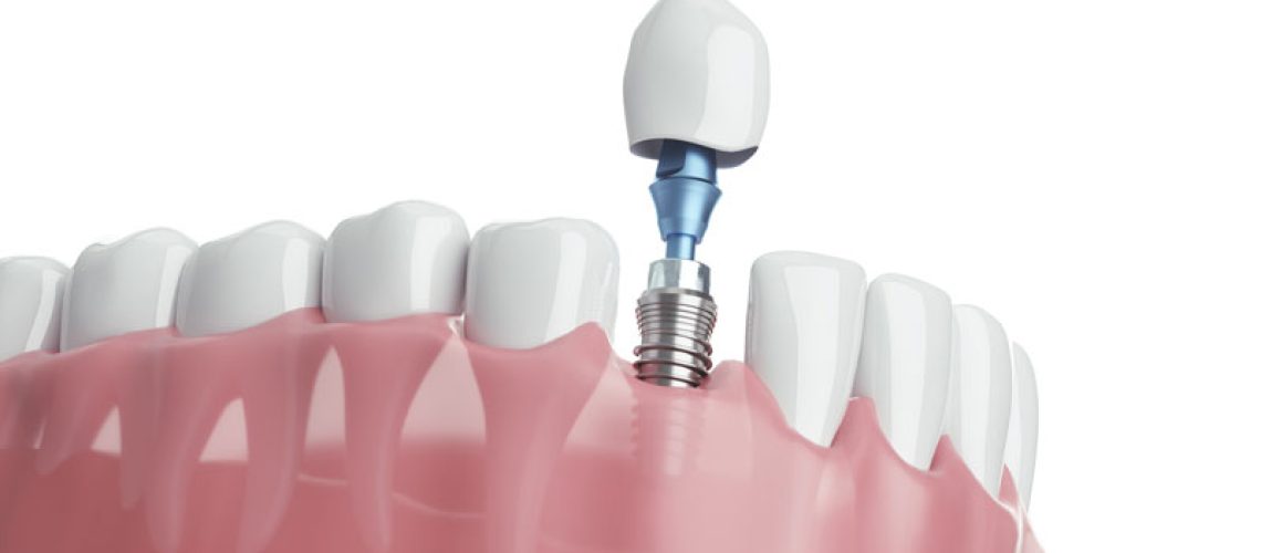 a digital model of a lower arch with a dental implant being placed after a tooth extraction.