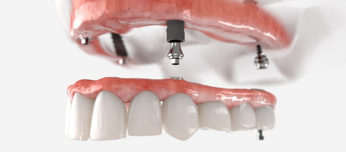 a full mouth dental implant model that shows how they can functionally benefit patients with their strategically placed dental implant posts and custom made prosthesis. The abutment and screws shown in the image help keep the prosthesis in place.