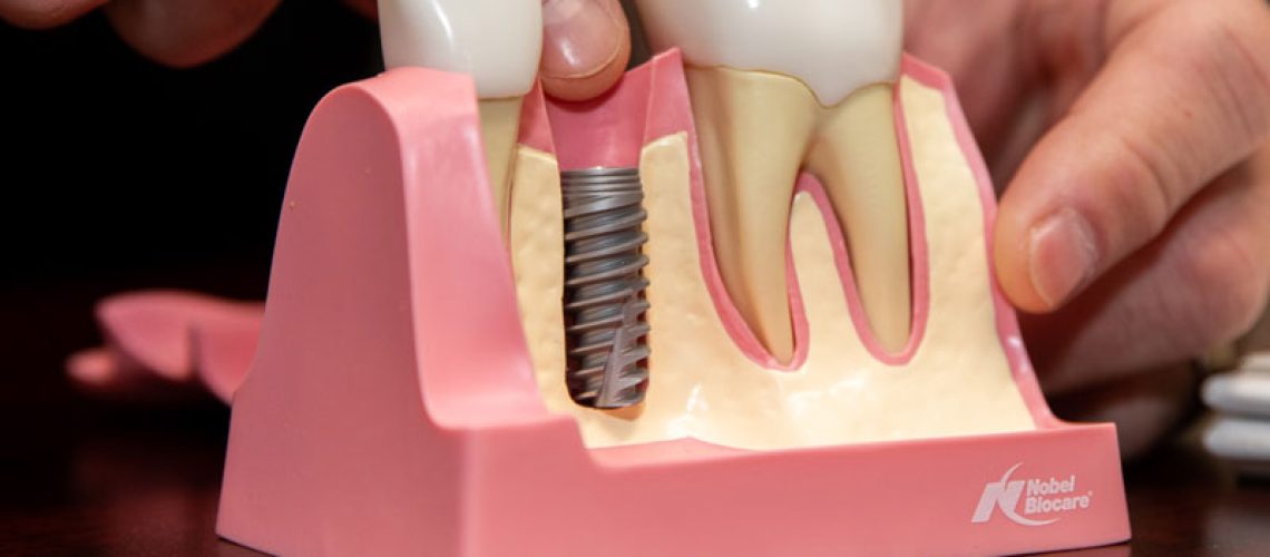 a dental implant post in jaw model.