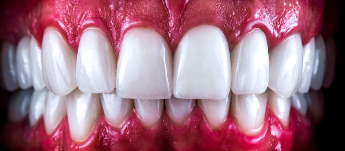 a set of full mouth dental implants after placement.