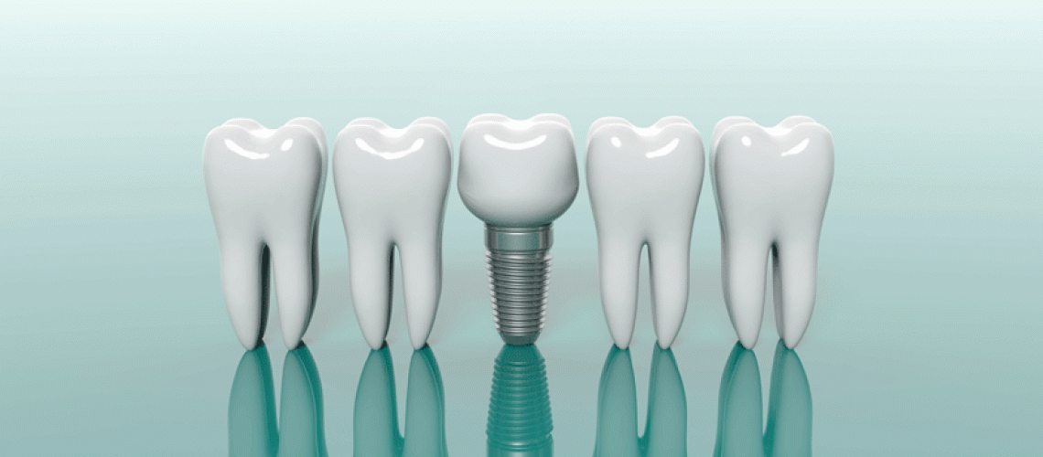 3d model of 4 teeth with a dental implant in the middle of them