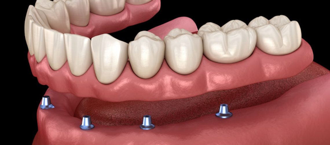 a digital model of a bottom arch showing implant supported dentures.