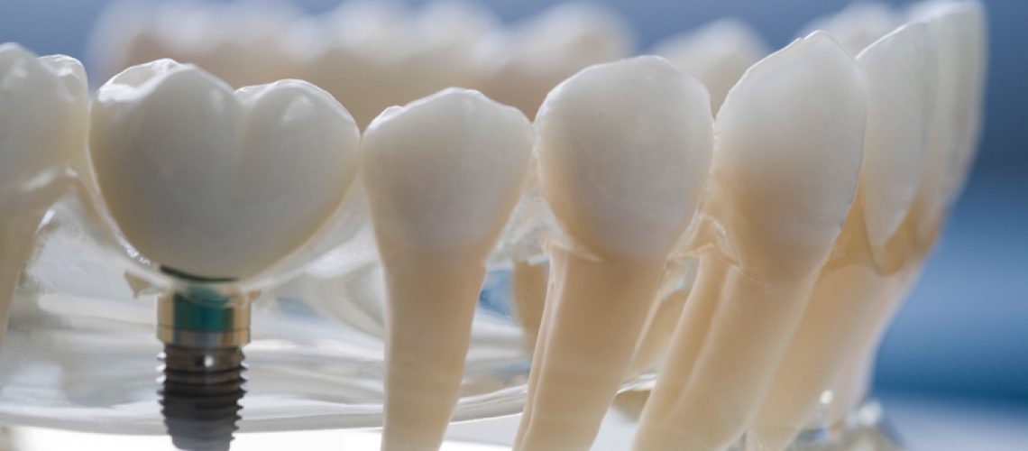 Image of a prosthesis jaw with a implant.